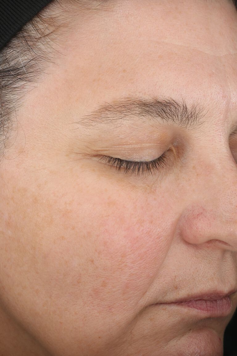 Day 1 of a second woman before application of Miracle Set.