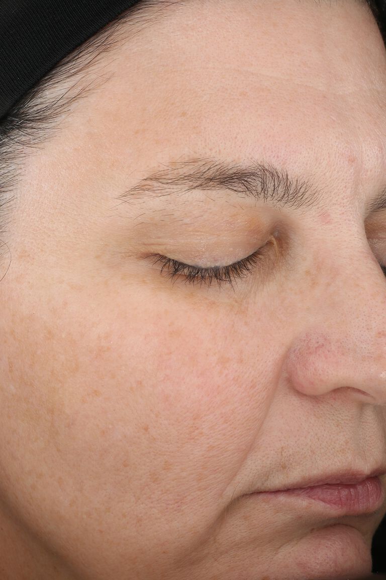 Week 12 of second woman after application of Mircale Set.