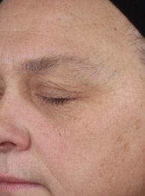 Sujeto A antes de usar el suero Facial Retinol 0.3 Mary Kay&reg; Clinical Solutions&reg;