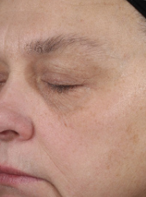 Sujeto A despu&eacute;s de usar Suero Facial Retinol 0.3 Mary Kay&reg; Clinical Solutions&reg; por la noche durante 12 semanas